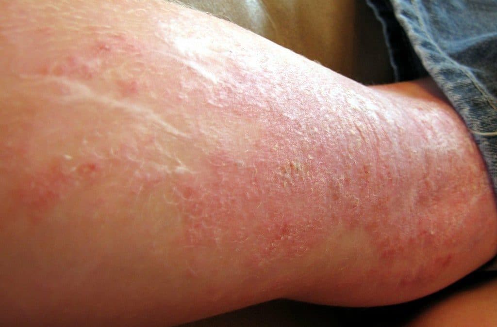 How Eczema Can Be Treated with Cannabis